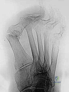 أشعة سينية تظهر التشوه المعقد بعد الجراحة الفاشلة