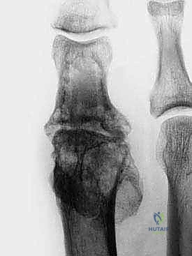 النخر اللاوعائي وتآكل المفصل