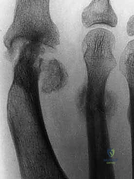 تأثير الالتهابات على الهيكل العظمي للقدم