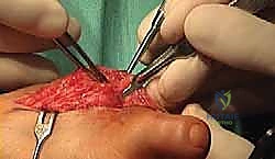 التشريح الدقيق لمفصل إبهام القدم الكبير