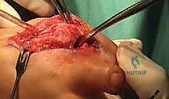 صورة توضيحية لـ اندماج مفصل إبهام القدم بتطعيم العظام: دليل شامل لاستعادة وظيفة القدم مع الأستاذ الدكتور محمد هطيف