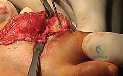 التثبيت النهائي باستخدام شريحة معدنية ومسامير قلوظة