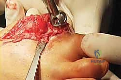 صورة شعاعية أخرى توضح التئام العظام