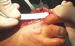 صورة توضح التئام الجرح الأولي