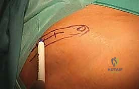 صورة أخرى للأشعة أثناء العملية