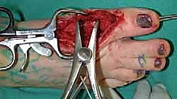 صورة أخرى للجرح بعد إزالة الغرز