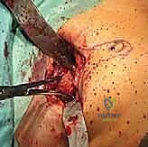 صورة توضيحية لـ اندماج مفصل إبهام القدم بتطعيم العظام: دليل شامل لاستعادة وظيفة القدم مع الأستاذ الدكتور محمد هطيف