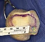 صورة توضيحية لـ اندماج مفصل إبهام القدم بتطعيم العظام: دليل شامل لاستعادة وظيفة القدم مع الأستاذ الدكتور محمد هطيف