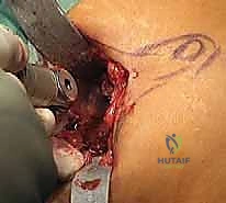 اندماج مفصل إبهام القدم بتطعيم العظام: دليل شامل لاستعادة وظيفة القدم مع الأستاذ الدكتور محمد هطيف