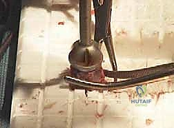 صورة توضيحية لـ اندماج مفصل إبهام القدم بتطعيم العظام: دليل شامل لاستعادة وظيفة القدم مع الأستاذ الدكتور محمد هطيف