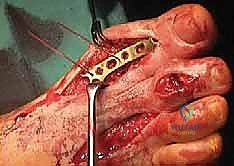 استخدام جهاز التشتيت لقياس الفجوة