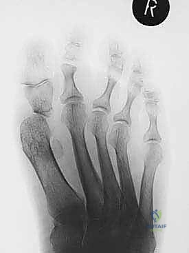 تحضير سطح العظم المشطي