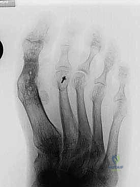حصاد الطعم العظمي من الحوض