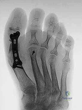 التثبيت المبدئي بأسلاك كيرشنر