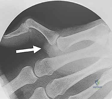 استخدام الجبيرة المخصصة للإبهام