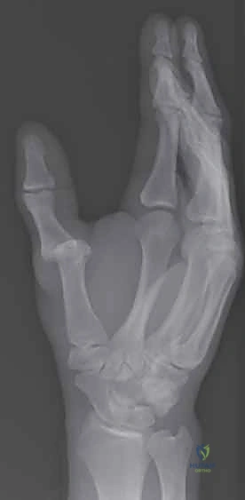 تثبيت المفصل السنعي السلامي