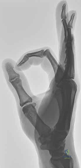 مراحل الشفاء بدون جراحة