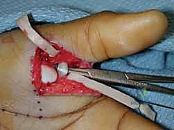 إجهاد المفصل المزمن