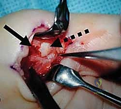 صورة طبية: عدم استقرار وخلع مفصل الإبهام السنعي السلامي: دليلك الشامل للعلاج الجراحي وغير الجراحي في صنعاء مع الأستاذ الدكتور محمد هطيف