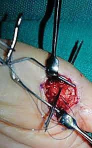 صورة توضيحية لـ عدم استقرار وخلع مفصل الإبهام السنعي السلامي: دليلك الشامل للعلاج الجراحي وغير الجراحي في صنعاء مع الأستاذ الدكتور محمد هطيف