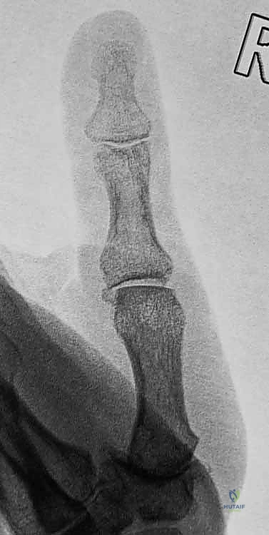 صورة طبية: عدم استقرار وخلع مفصل الإبهام السنعي السلامي: دليلك الشامل للعلاج الجراحي وغير الجراحي في صنعاء مع الأستاذ الدكتور محمد هطيف