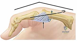 صورة توضيحية لـ عدم استقرار وخلع مفصل الإبهام السنعي السلامي: دليلك الشامل للعلاج الجراحي وغير الجراحي في صنعاء مع الأستاذ الدكتور محمد هطيف