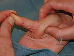 صورة توضيحية لـ عدم استقرار وخلع مفصل الإبهام السنعي السلامي: دليلك الشامل للعلاج الجراحي وغير الجراحي في صنعاء مع الأستاذ الدكتور محمد هطيف