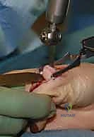 صورة توضيحية لـ عدم استقرار وخلع مفصل الإبهام السنعي السلامي: دليلك الشامل للعلاج الجراحي وغير الجراحي في صنعاء مع الأستاذ الدكتور محمد هطيف