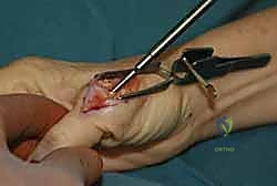 الأربطة الجانبية لمفصل الإبهام