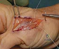 تورم الإبهام بعد الإصابة