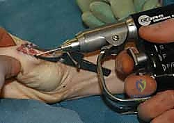 صورة توضيحية لـ عدم استقرار وخلع مفصل الإبهام السنعي السلامي: دليلك الشامل للعلاج الجراحي وغير الجراحي في صنعاء مع الأستاذ الدكتور محمد هطيف