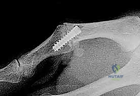 صورة طبية: عدم استقرار وخلع مفصل الإبهام السنعي السلامي: دليلك الشامل للعلاج الجراحي وغير الجراحي في صنعاء مع الأستاذ الدكتور محمد هطيف
