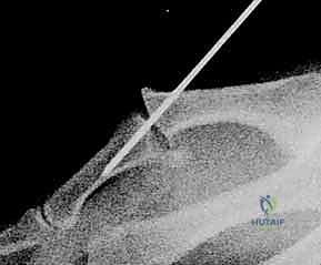 صورة طبية: عدم استقرار وخلع مفصل الإبهام السنعي السلامي: دليلك الشامل للعلاج الجراحي وغير الجراحي في صنعاء مع الأستاذ الدكتور محمد هطيف