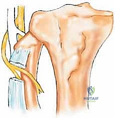 Illustration of type i resection - Dr. Mohammed Hutaif