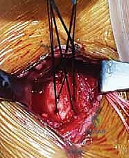 إصلاح تمزق العضلة الصدرية الكبرى: دليل شامل للمرضى مع الأستاذ الدكتور محمد هطيف