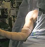 صورة توضيحية لـ إصلاح تمزق العضلة الصدرية الكبرى: دليل شامل للمرضى مع الأستاذ الدكتور محمد هطيف