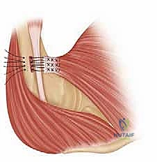 تحضير الوتر الممزق ووضع الغرز القوية