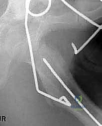 إجراء القطع العظمي وإزالة الإسفين