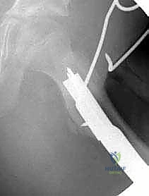 الدقة المتناهية في تحديد زوايا القطع العظمي