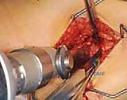 استخدام أحدث التقنيات في تثبيت الشريحة بزاوية 90 درجة