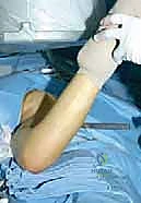 إدخال الشريحة النصلية بزاوية 90 درجة والتثبيت