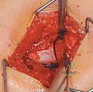 تخطيط جراحي دقيق لعملية قطع عظم الفخذ الداني مع الدكتور محمد هطيف