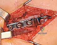 صورة توضيحية لـ قطع عظم الفخذ الداني التقويمي (فاروس) بشريحة 90 درجة: حل دقيق لمشاكل الورك المعقدة مع الأستاذ الدكتور محمد هطيف