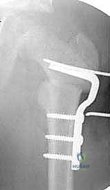 صورة توضيحية لـ قطع عظم الفخذ الداني التقويمي (فاروس) بشريحة 90 درجة: حل دقيق لمشاكل الورك المعقدة مع الأستاذ الدكتور محمد هطيف