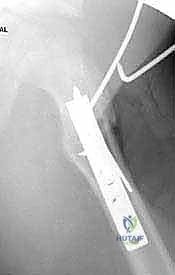 حالة مرض بيرثيس وتخطيط العلاج الجراحي لها