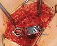 أشعة سينية توضح وضع المفصل قبل وبعد التعديل