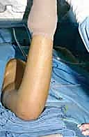 صورة توضيحية لـ قطع عظم الفخذ الداني التقويمي (فاروس) بشريحة 90 درجة: حل دقيق لمشاكل الورك المعقدة مع الأستاذ الدكتور محمد هطيف