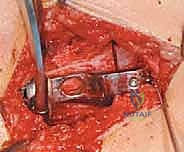 صورة توضح التثبيت الصلب باستخدام الشريحة النصلية