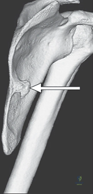 صورة توضيحية لـ متلازمة الكتف الطرقعي: دليل شامل للعلاج والتعافي مع الأستاذ الدكتور محمد هطيف