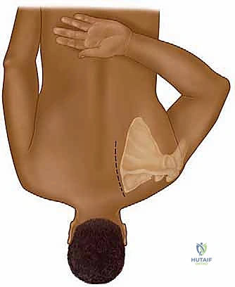 التشخيص الإشعاعي لمتلازمة الكتف الطرقعي